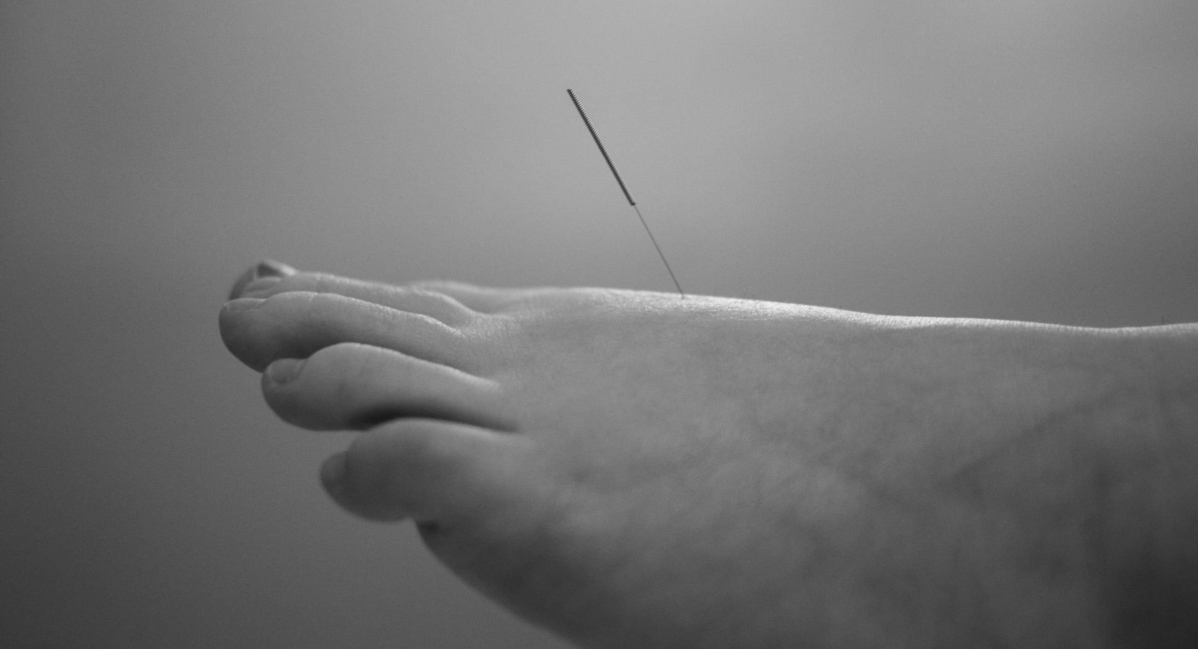 Photo of a foot with an acupuncture needle